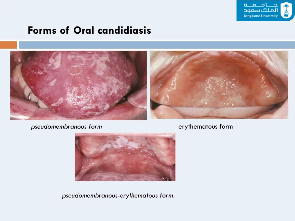 forms of oral candidiasis