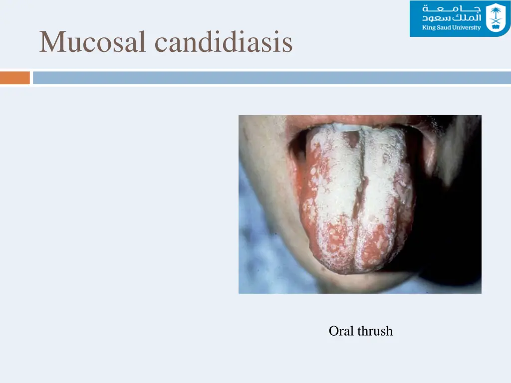 mucosal candidiasis