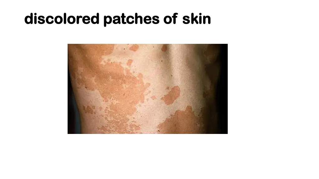 discolored patches of skin discolored patches