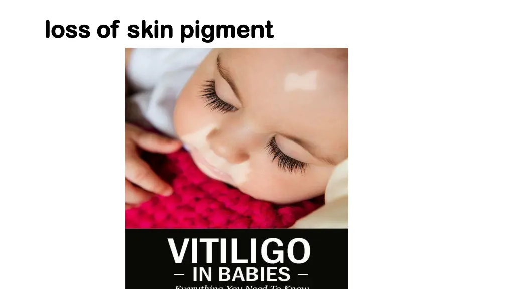 loss of skin pigment loss of skin pigment