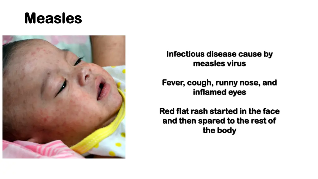 measles measles