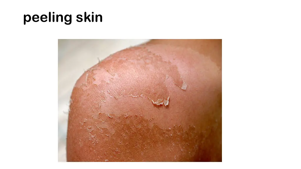 peeling skin