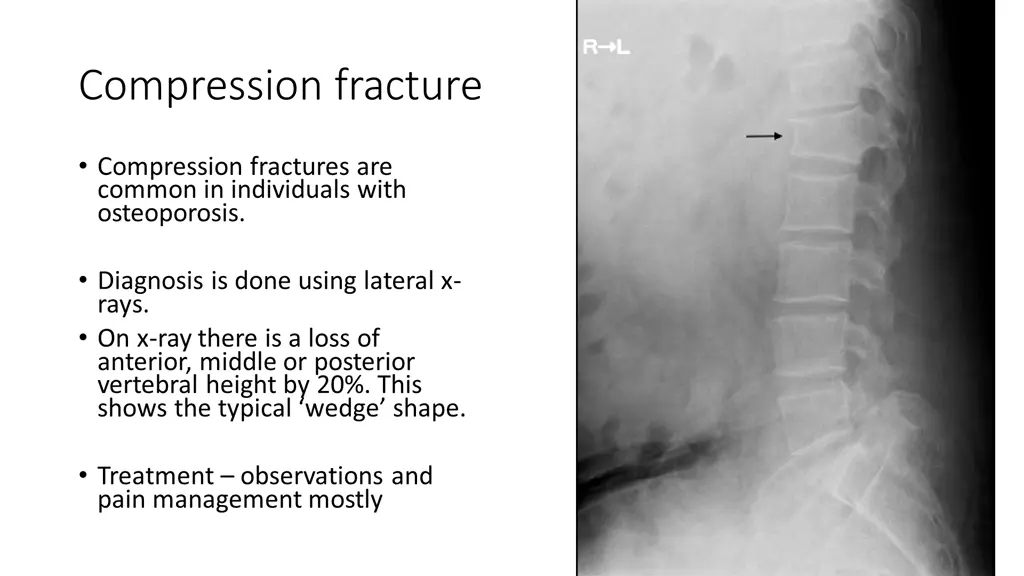 compression fracture