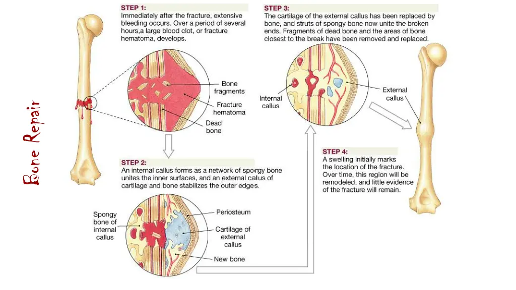 bone repair