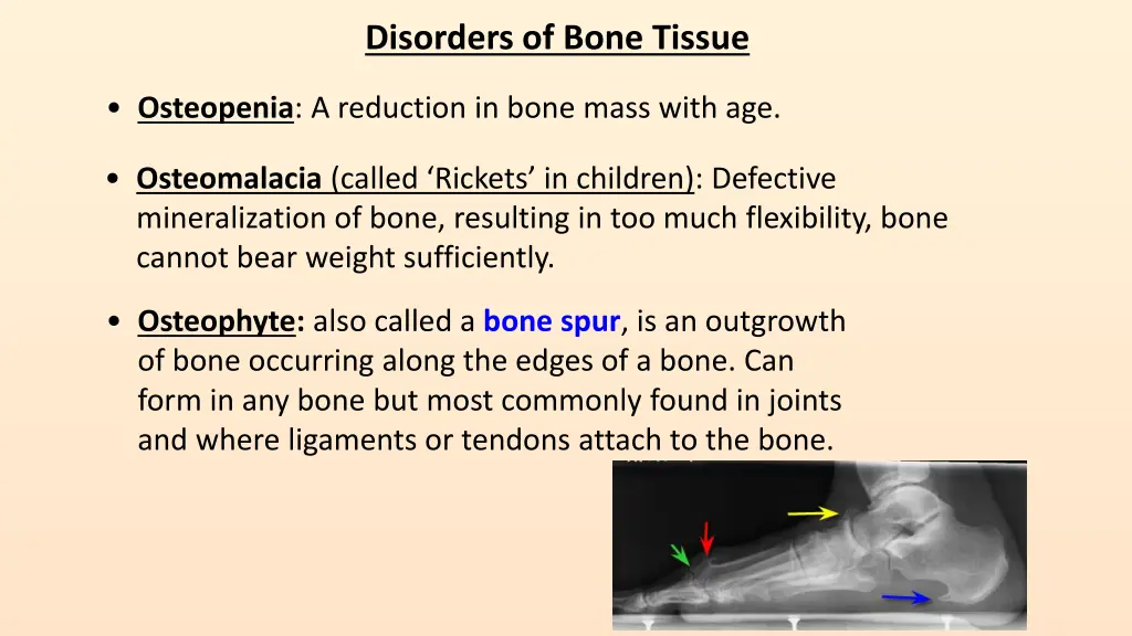 disorders of bone tissue