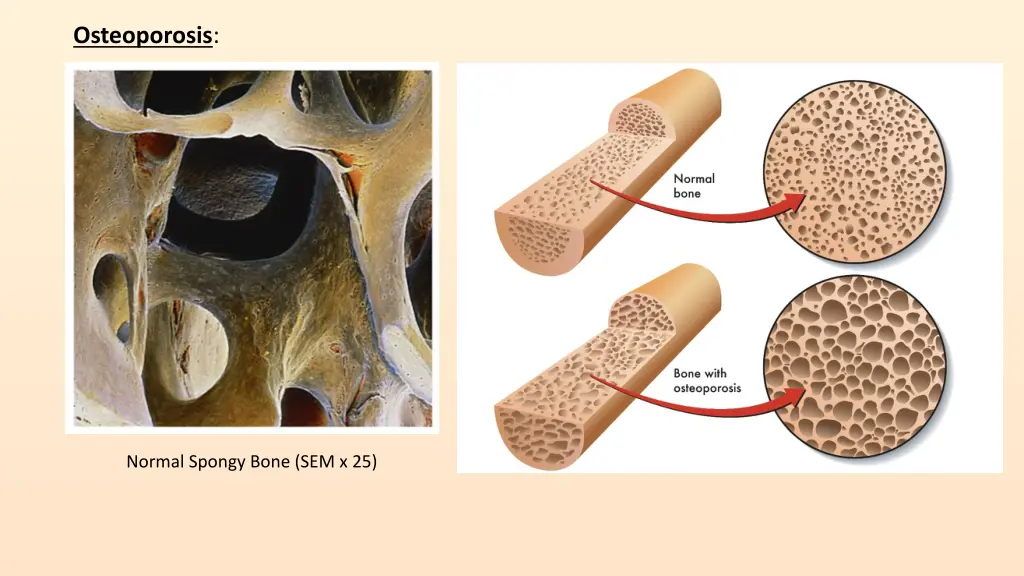 osteoporosis