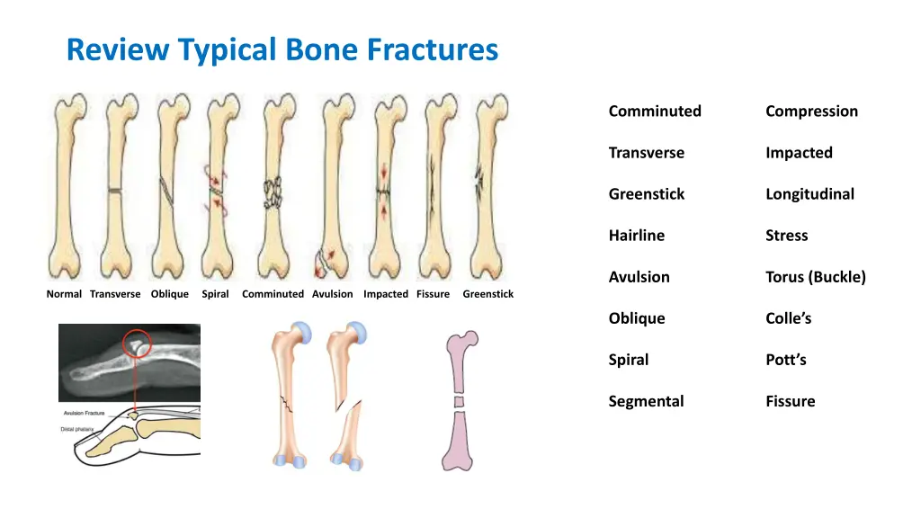 review typical bone fractures