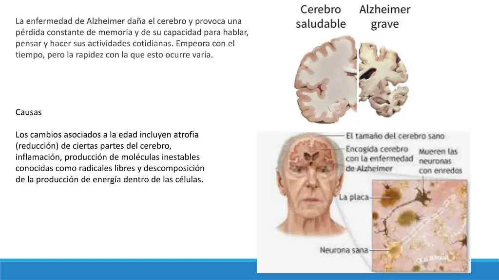 la enfermedad de alzheimer da a el cerebro