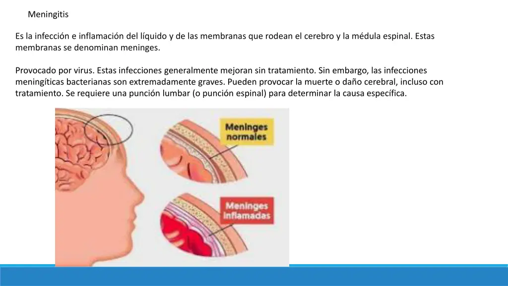 meningitis