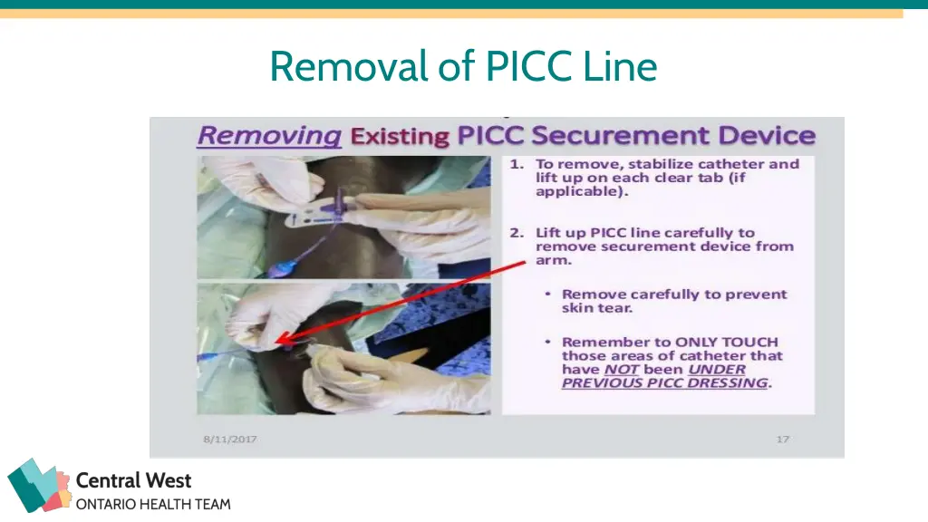 removal of picc line 2