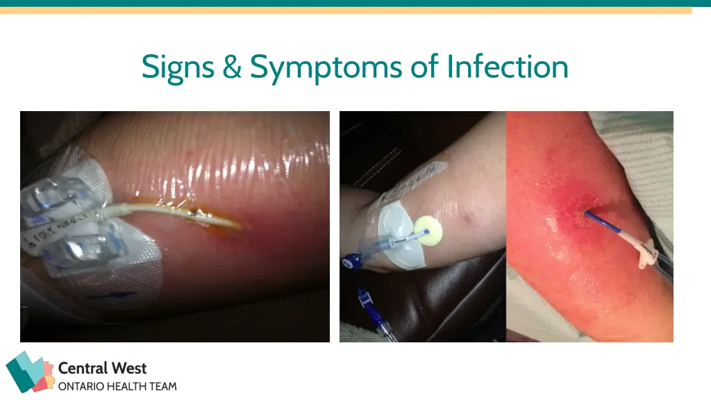 signs symptoms of infection