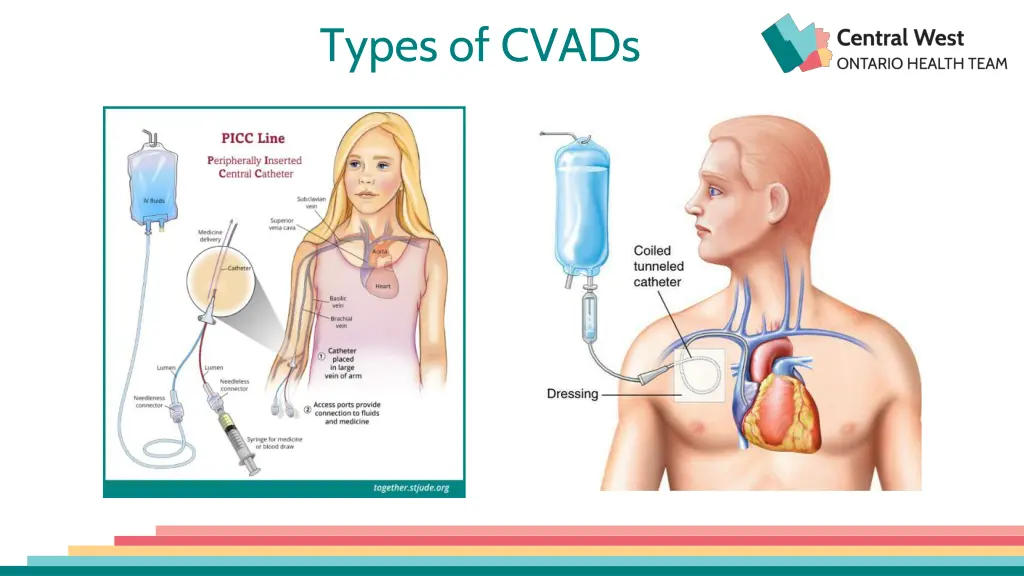 types of cvads 1