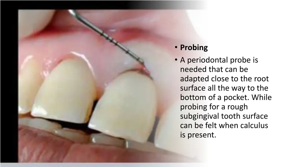 probing a periodontal probe is needed that