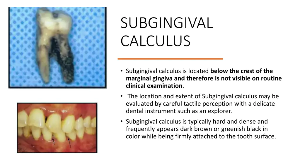 subgingival calculus