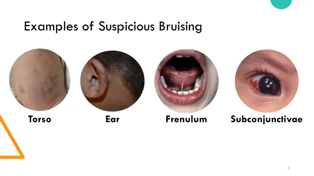 examples of suspicious bruising