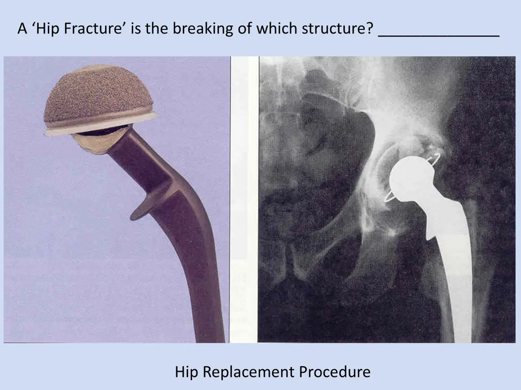 a hip fracture is the breaking of which structure