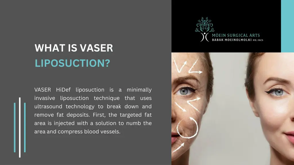 what is vaser liposuction