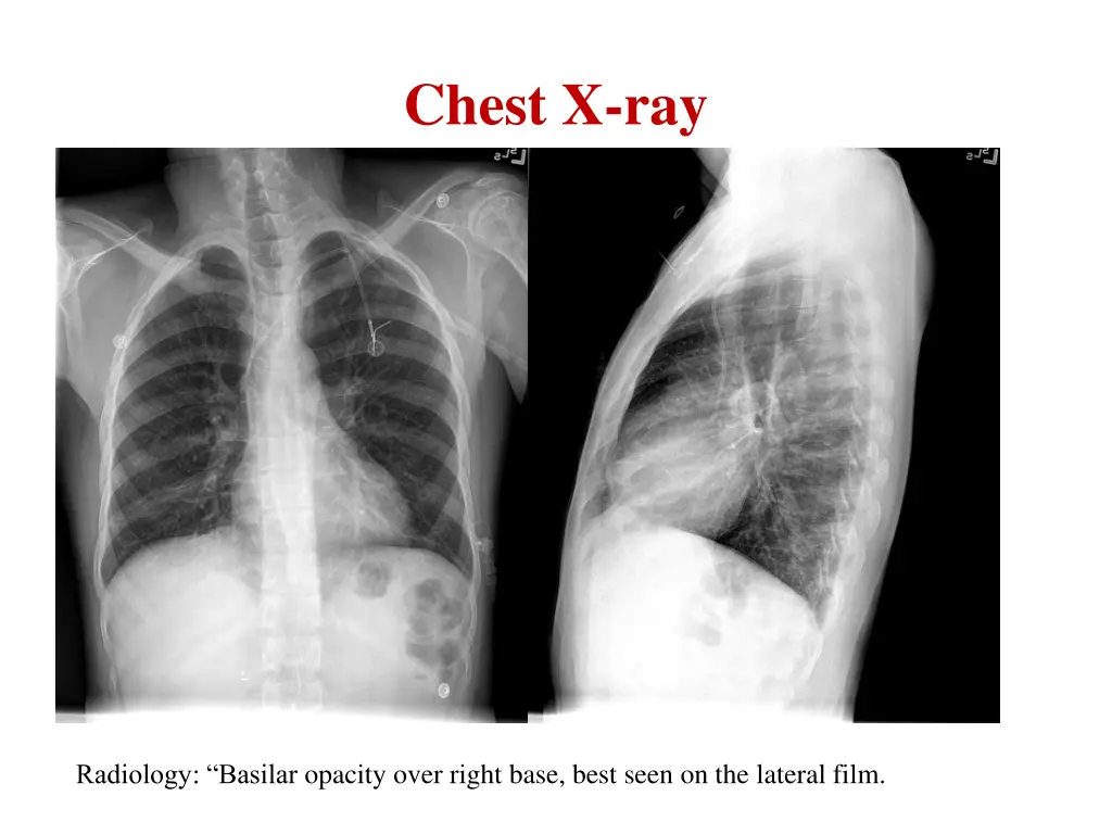 chest x ray