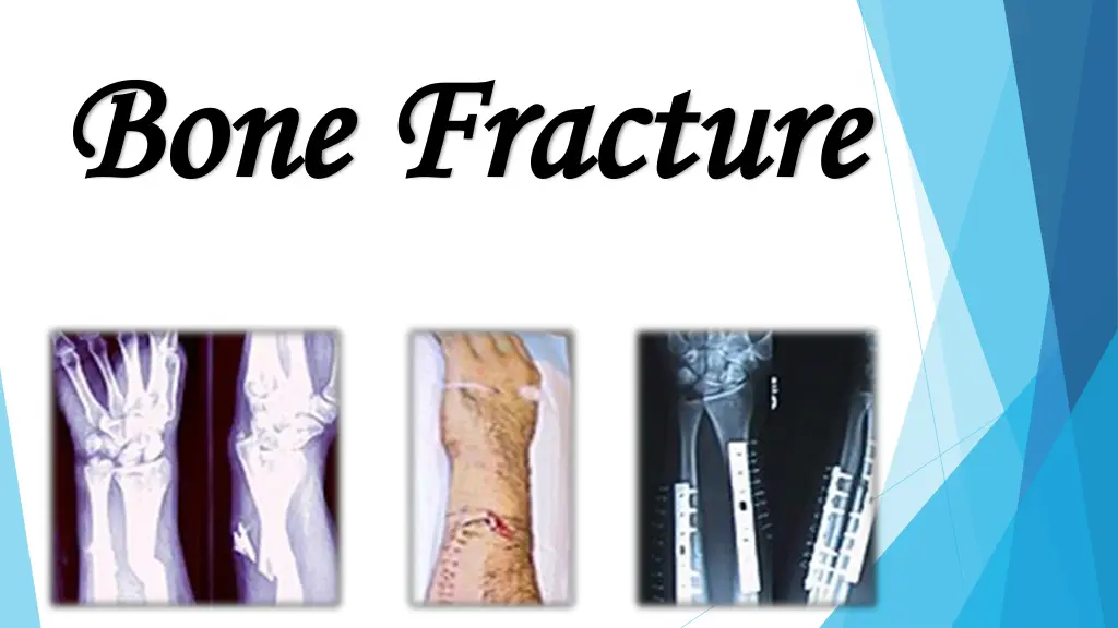 bone bone fracture fracture