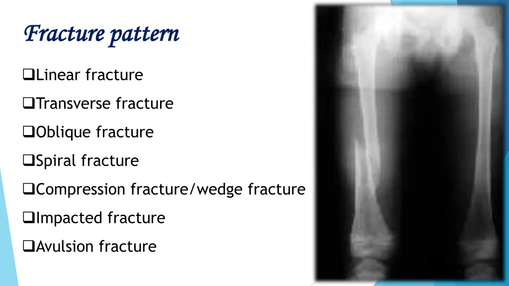 fracture pattern fracture pattern