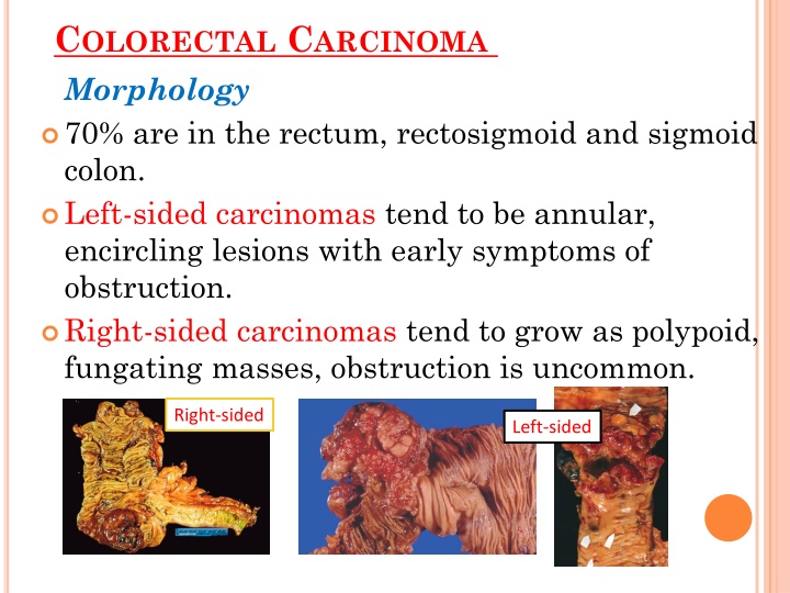 c olorectal c arcinoma morphology