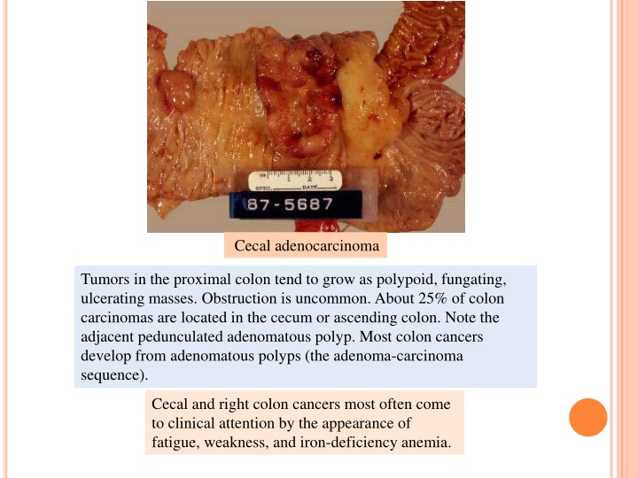 cecal adenocarcinoma