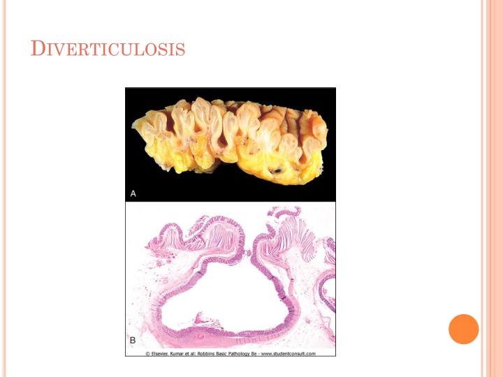 d iverticulosis