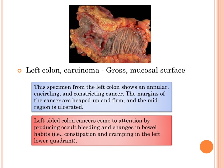 left colon carcinoma gross mucosal surface