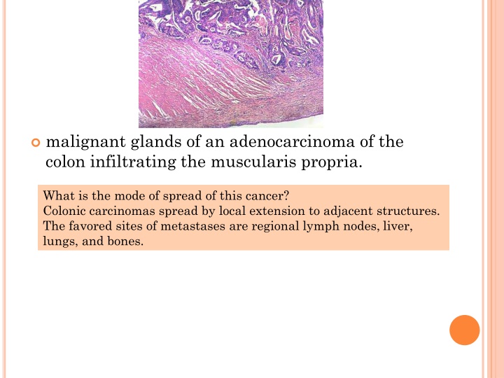 malignant glands of an adenocarcinoma