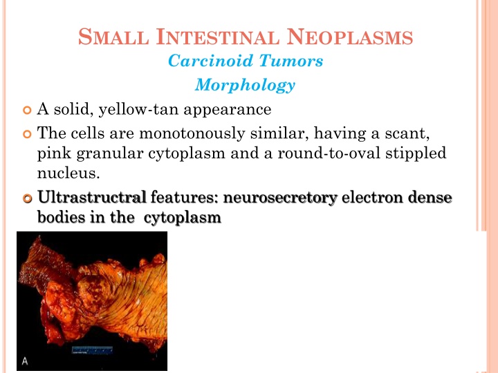 s mall i ntestinal n eoplasms carcinoid tumors 1