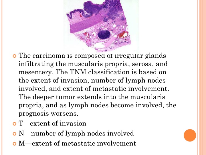 the carcinoma is composed of irregular glands