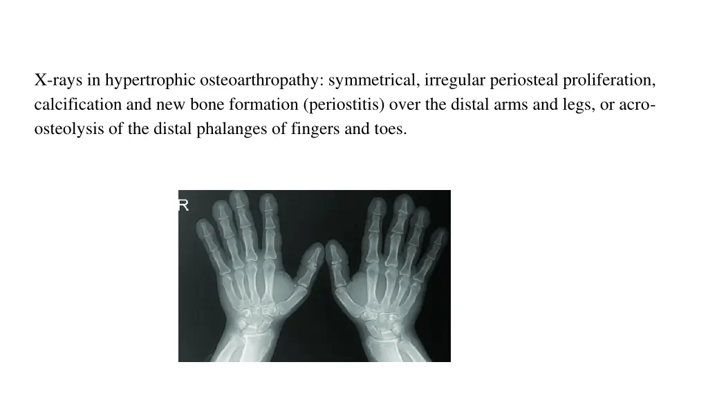 x rays in hypertrophic osteoarthropathy