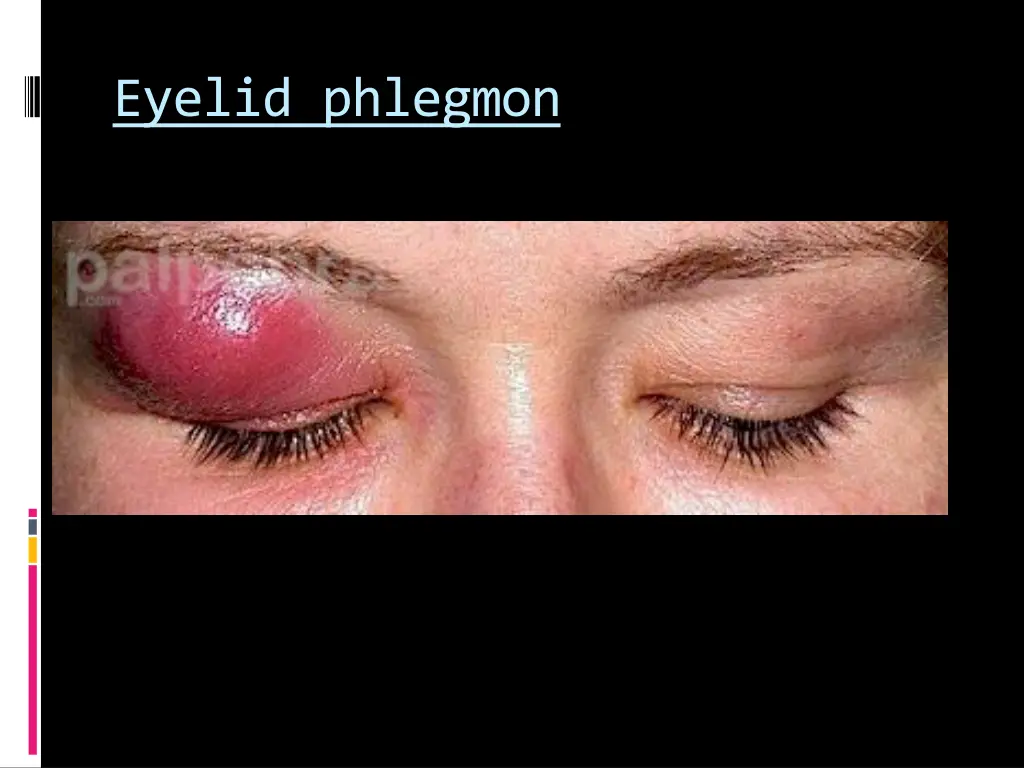 eyelid phlegmon