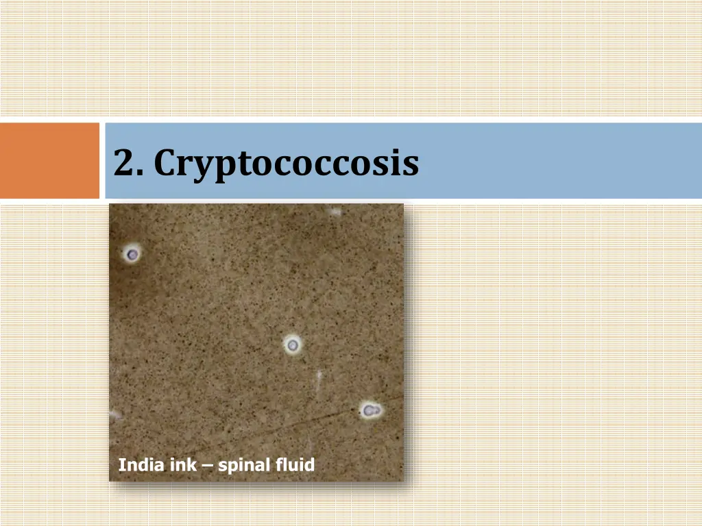 2 cryptococcosis