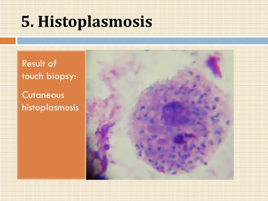 5 histoplasmosis