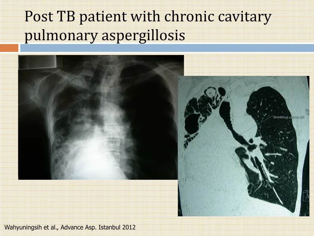 post tb patient with chronic cavitary pulmonary