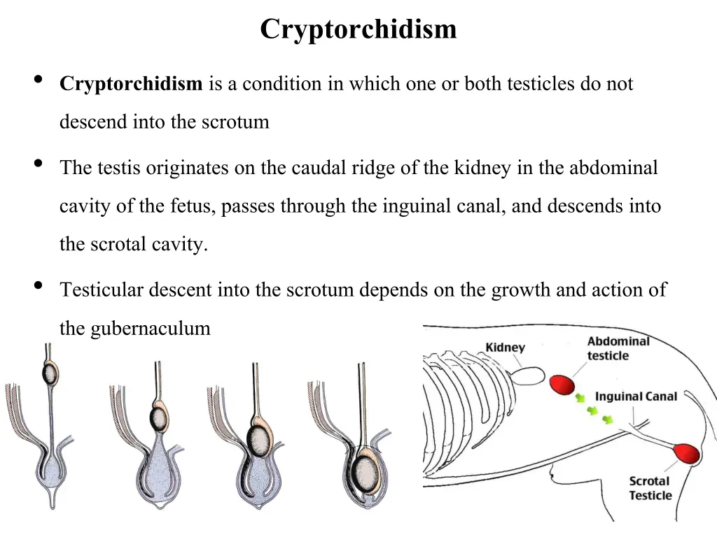 cryptorchidism