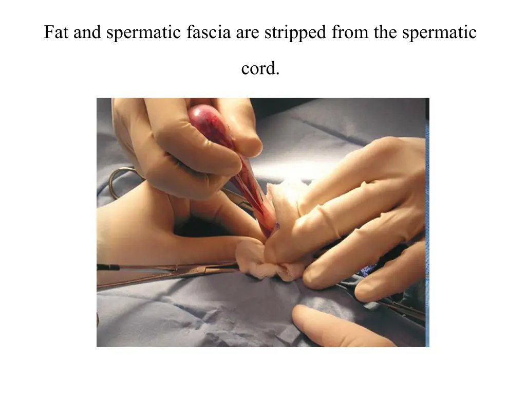 fat and spermatic fascia are stripped from