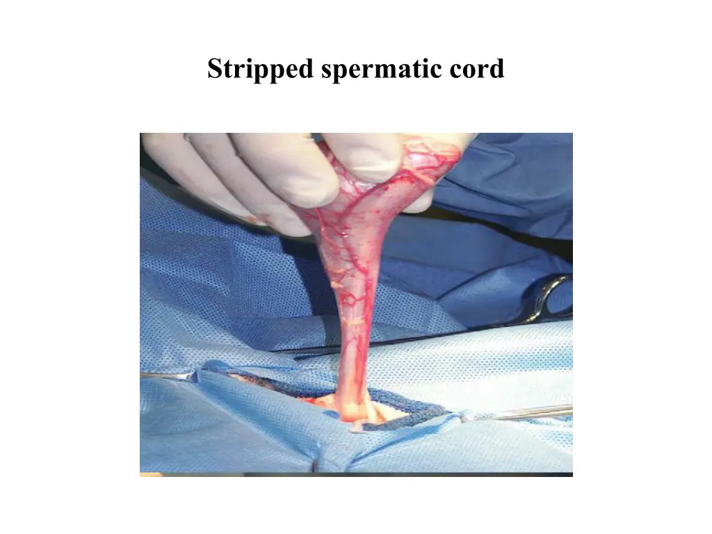 stripped spermatic cord