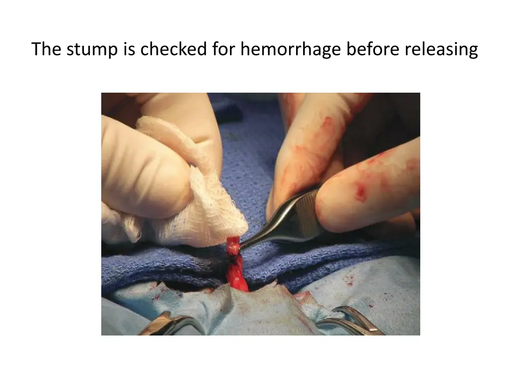 the stump is checked for hemorrhage before