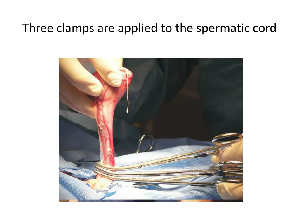three clamps are applied to the spermatic cord