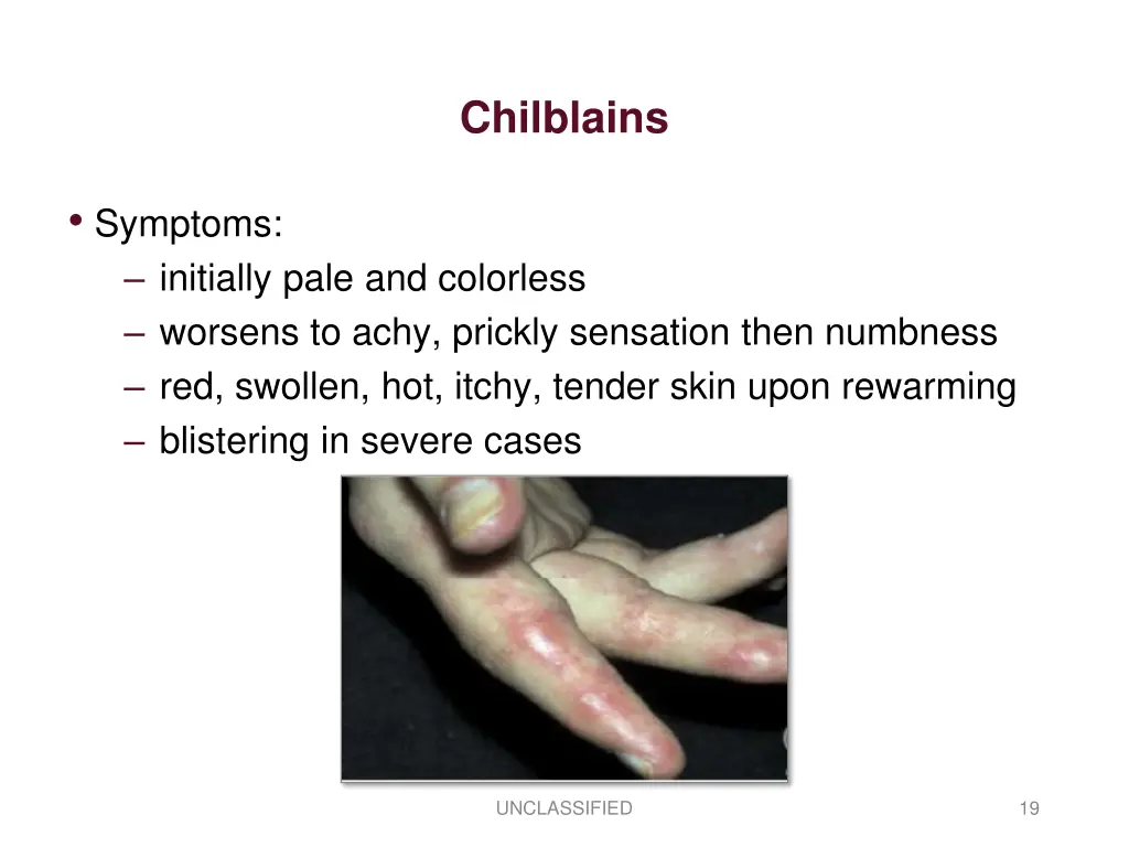 chilblains 1