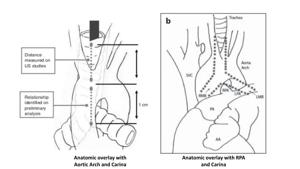 anatomic overlay with aortic arch and carina