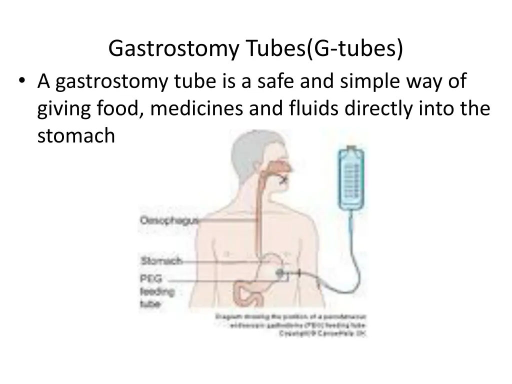 gastrostomy tubes g tubes a gastrostomy tube