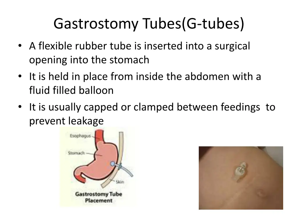 gastrostomy tubes g tubes