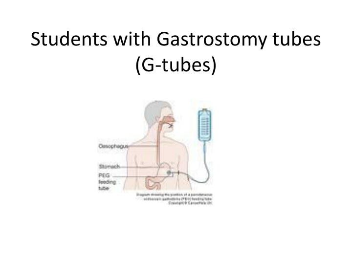 students with gastrostomy tubes g tubes