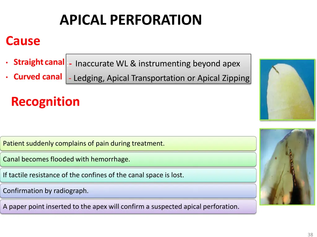 apical perforation