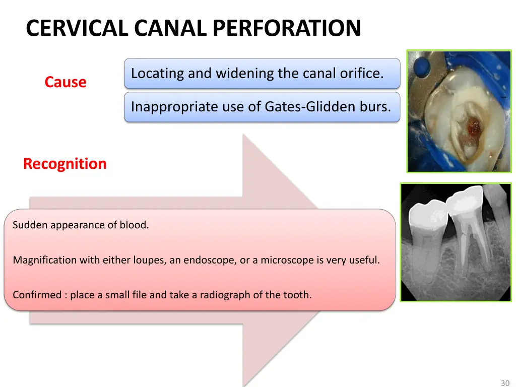 cervical canal perforation