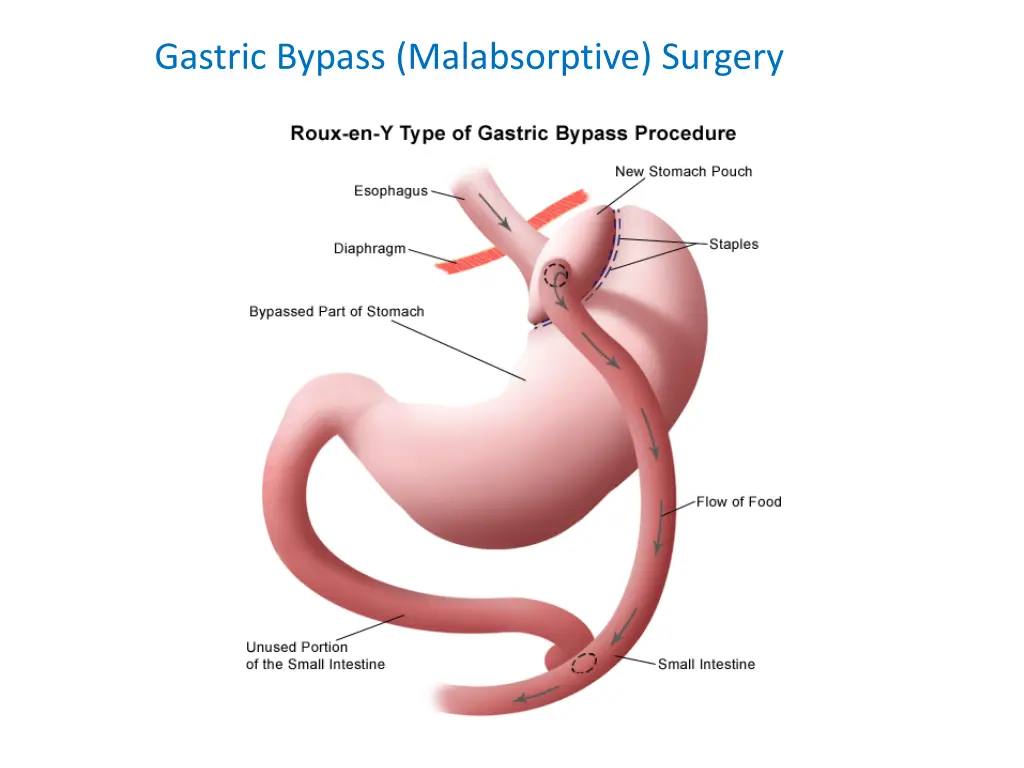 gastric bypass malabsorptive surgery