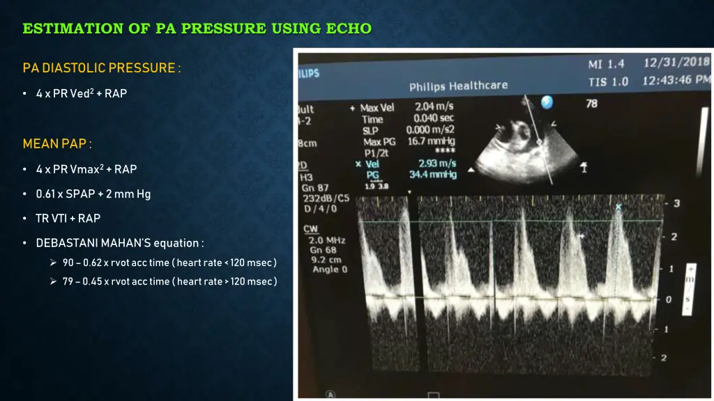 estimation of pa pressure using echo 1